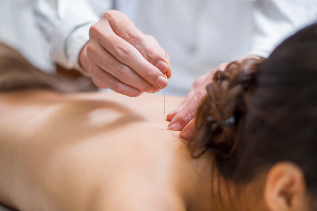 Young woman receiving acupuncture